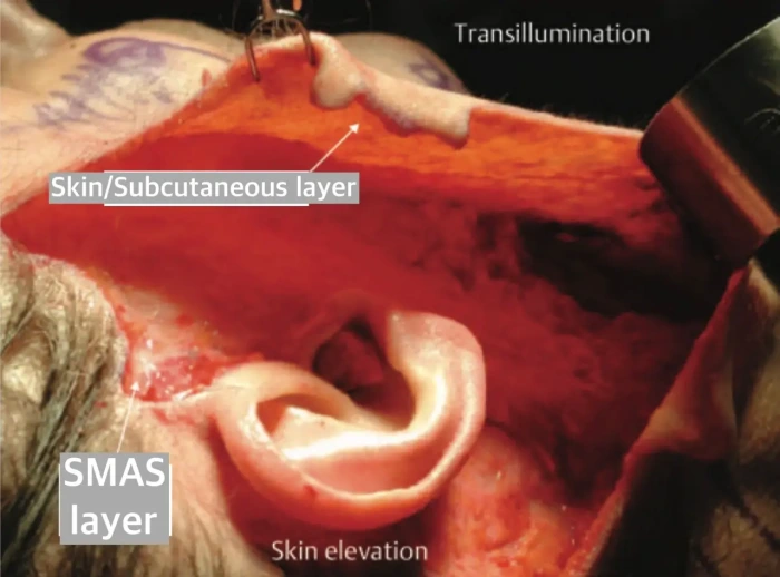 facelift dual plane subcutaneous and SMAS dissection