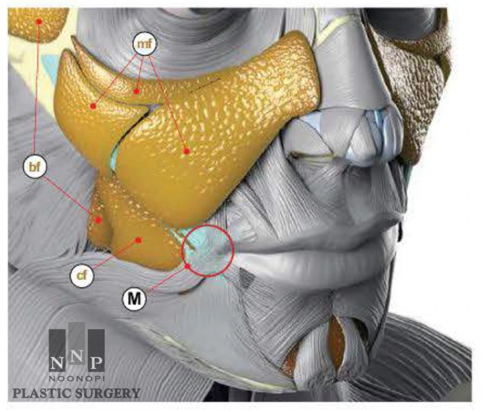Illustration of facial fat compartment affected by the pulling direction (vector) of SMAS