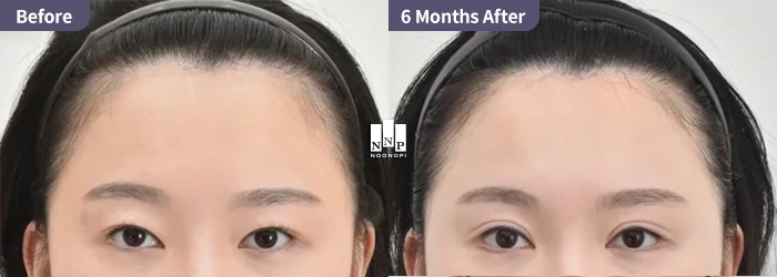 Before and after of an Asian patient achieving larger, more open eyes and maximized pupil exposure through lateral and lowering epicanthoplasty
