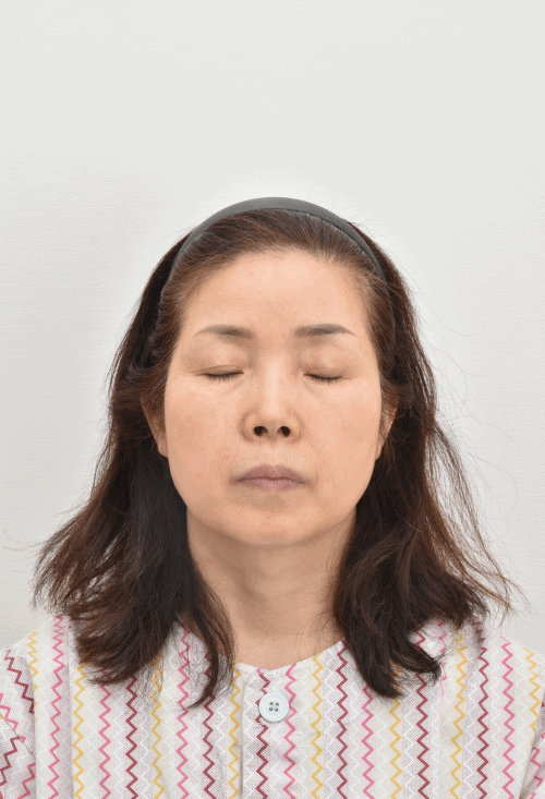 上睑凹陷通过脂肪移植得以填充