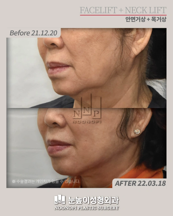 절개거상 후 심부볼이 개선된 모습