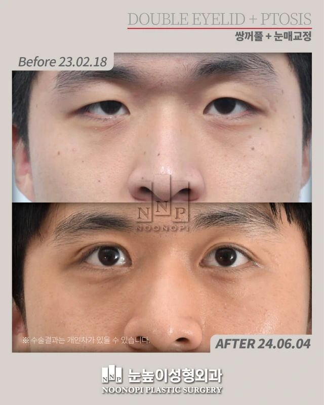 korea ptosis surgery before after