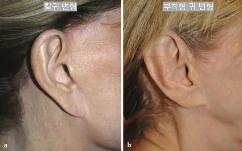 面部提升术后耳垂畸形