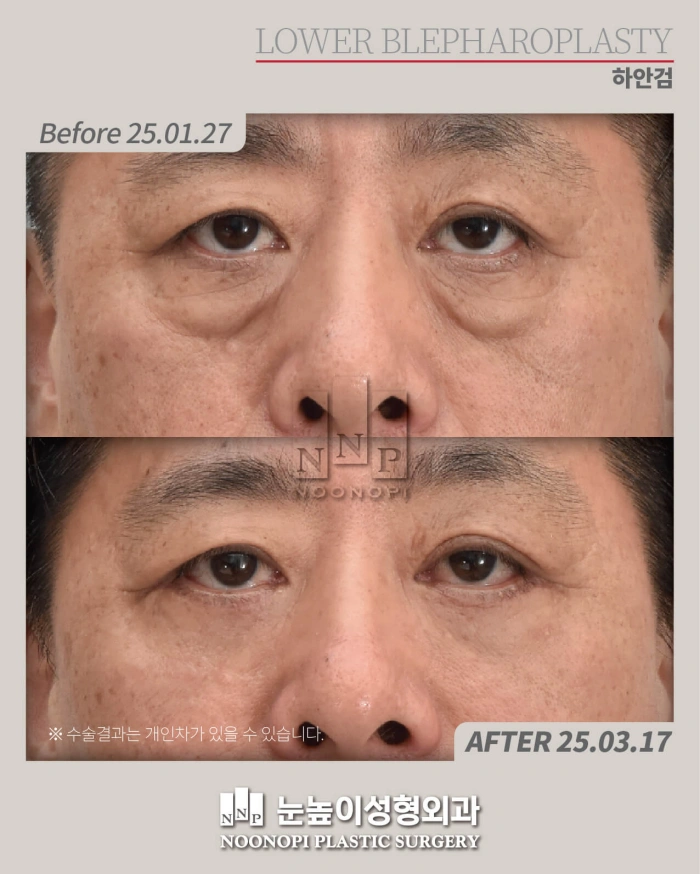 before after photo of lower eyelid surgery in age 50s