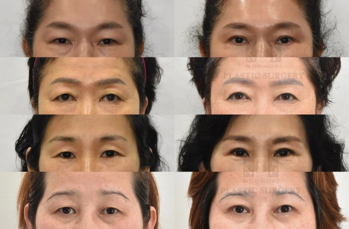 رفع الجفن العلوي الطبيعي قبل وبعد