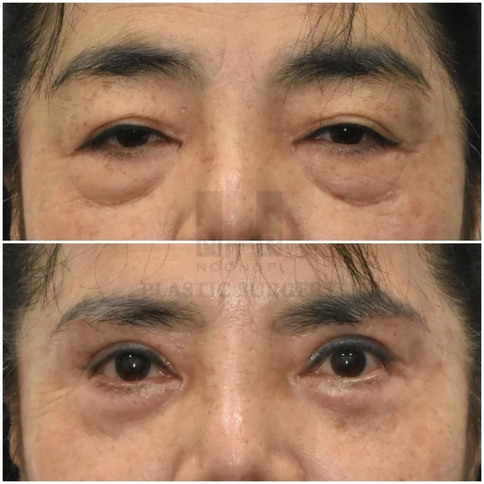 上睑成形术联合眉部提升术及下睑成形术
