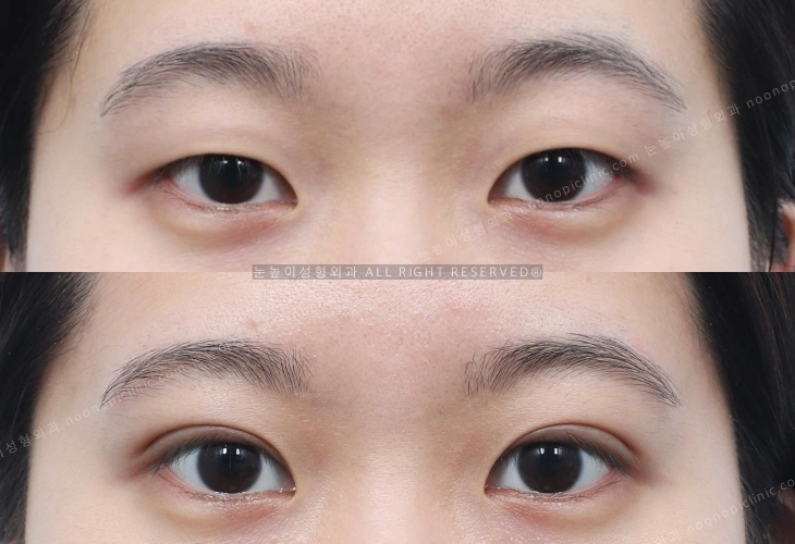 Incisional double eyelid surgery, before and after