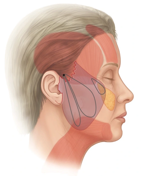 mini facelift approach