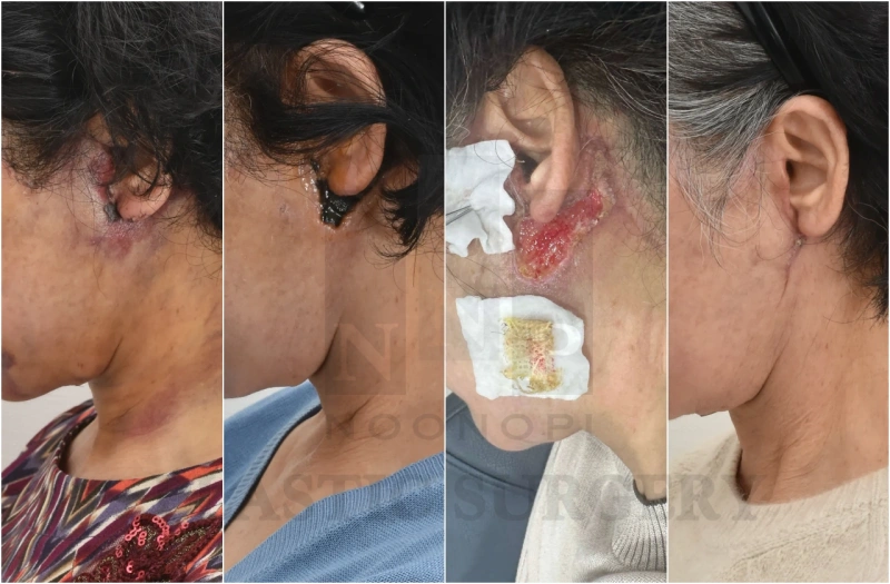 حالة Noonopi لعلاج نخر شد الوجه