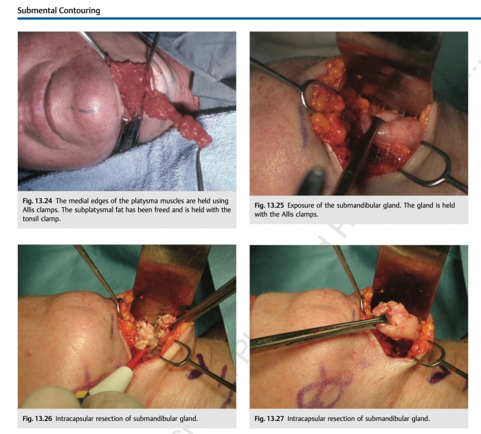 تصغير الغدد (المرجع تجديد شباب الوجه والرقبة)