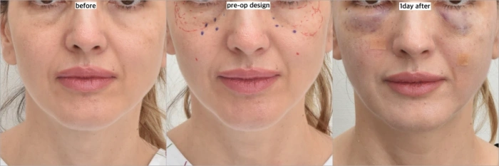 تقييم اليوم الأول لزراعة الدهون تحت العينين