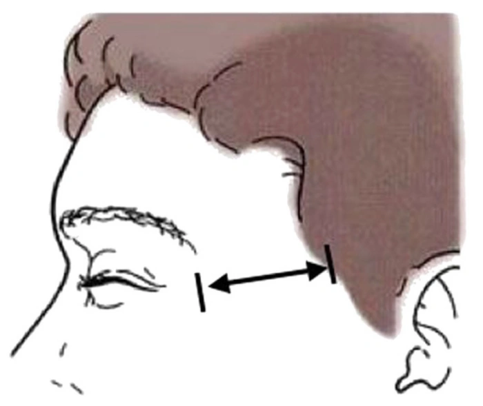 distance from the edge of the eye to the hairline