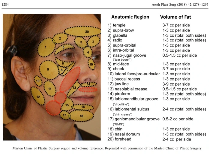 facial fat graft possible areas