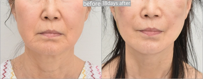 facelift recovery photos