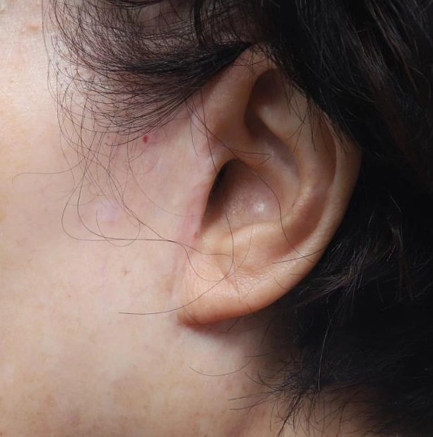 ear cartilage distortion after facelift