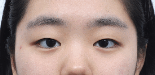쌍수 후 눈썹위치 변화