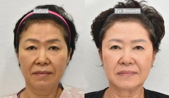 عملية تجميل الجفن العلوي في كوريا قبل وبعد