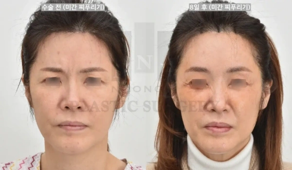 미간근육이 충분히 절제된 이마거상술 사례