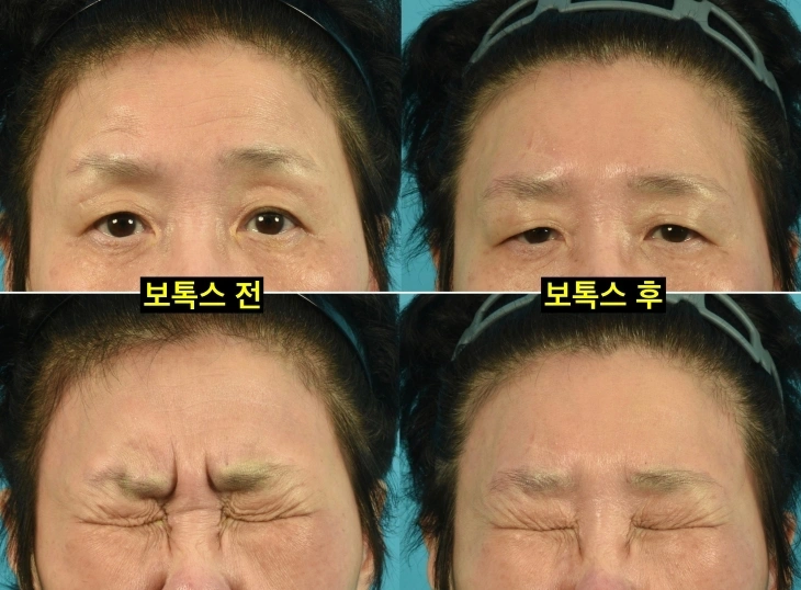 forehead botox before after