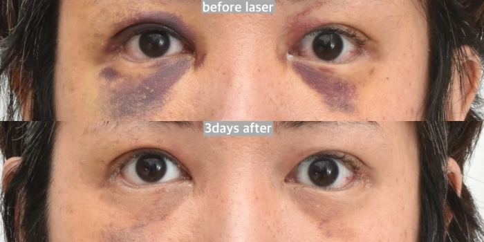 جلسة واحدة بعد الليزر لتقليل الكدمات بعد جراحة تكبير المؤخرة