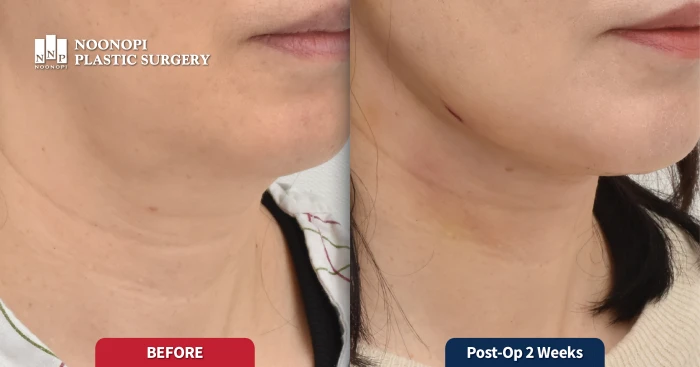 全颈部提升术前后对比