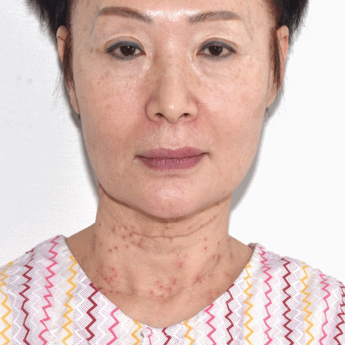 颞部脂肪注射术后6个月