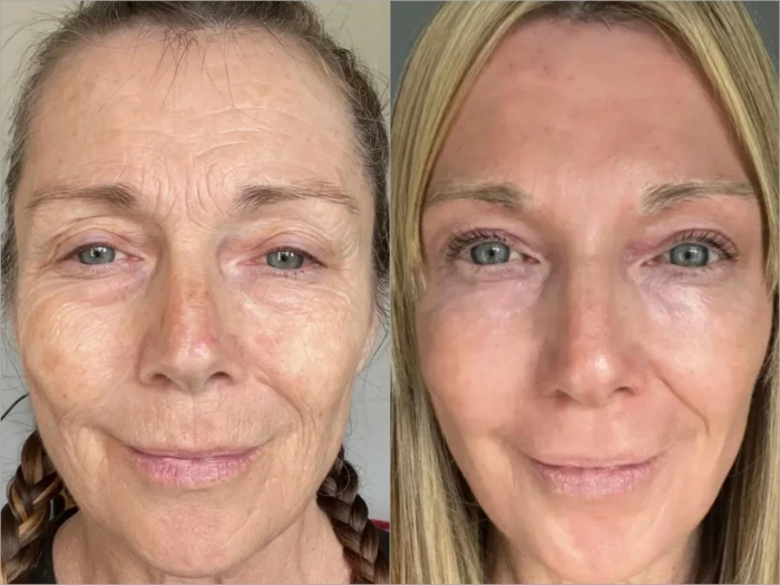 skin resurfacing before after in caucasian