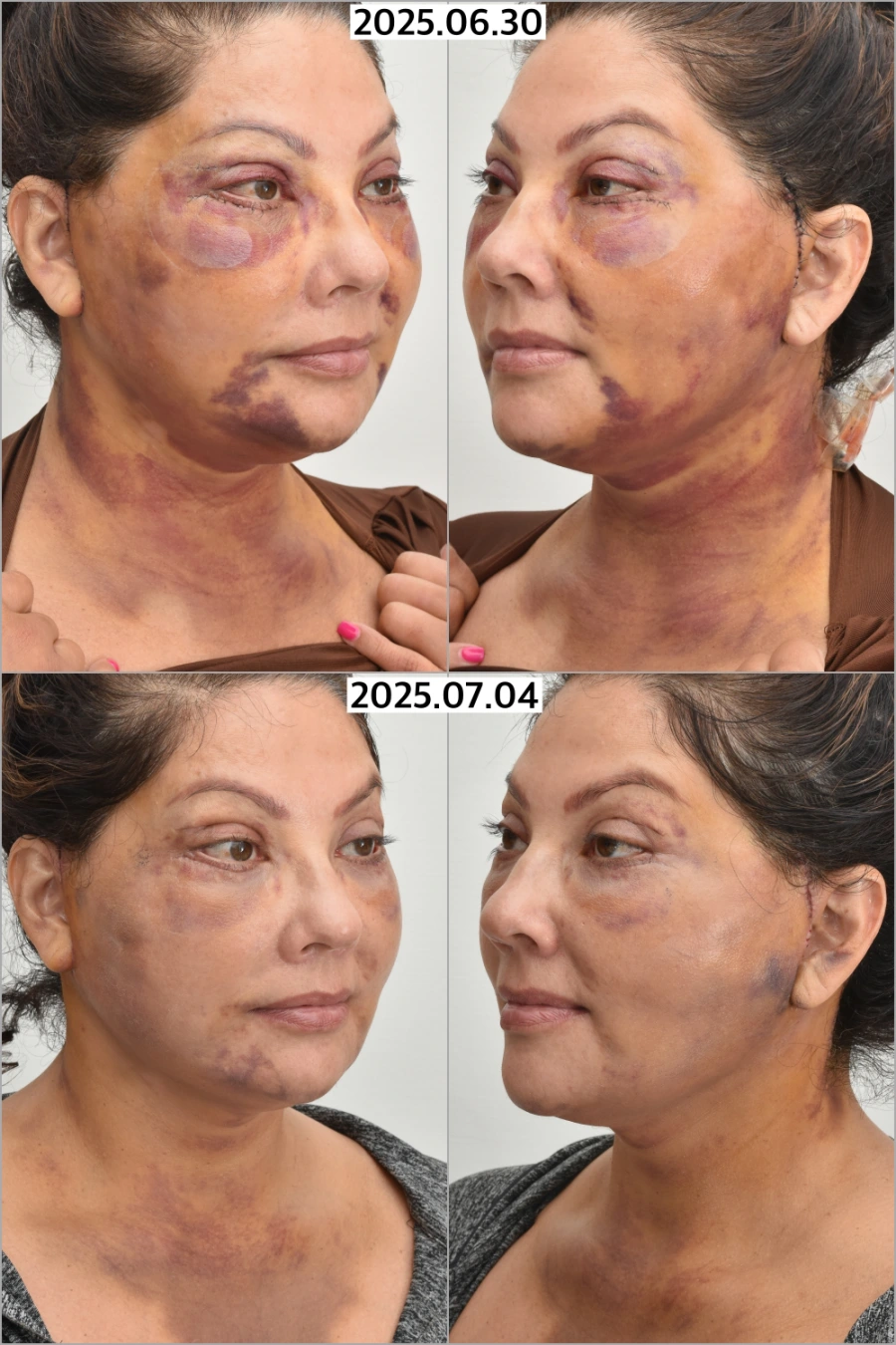 HBOT helps faster plastic surgery recovery
