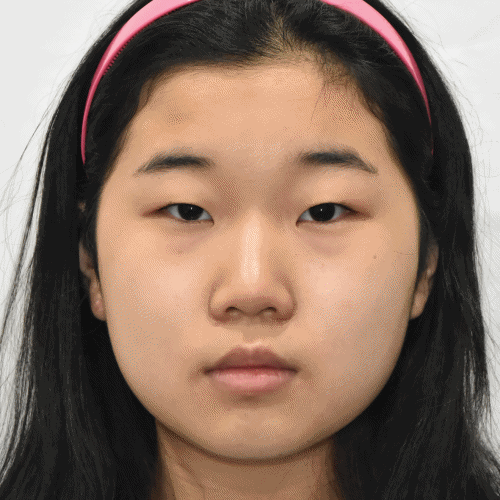 Young patient with brow descent after incisional double eyelid