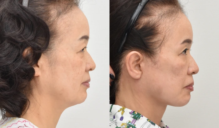 rhytidectomy before after