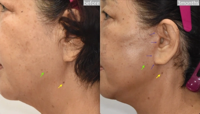 قبل وبعد. لاحظ انتقال البقع (السهم الأخضر والأصفر) والندوب الأقل وضوحًا (السهم الأزرق)