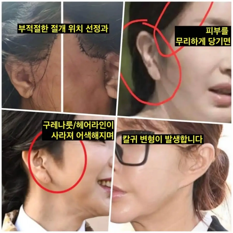 الآثار الجانبية لشد الوجه لدى مشاهير كوريين: تشوه خط الشعر (تم عمل وشم في الصورة العلوية) وتشوه شحمة الأذن بعد تخطيط سيئ للشق