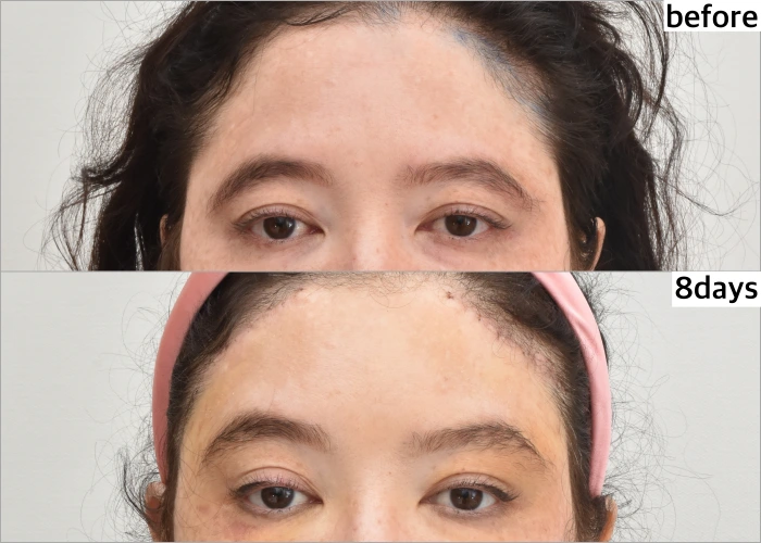 女性患者顳部提眉術前後對比照