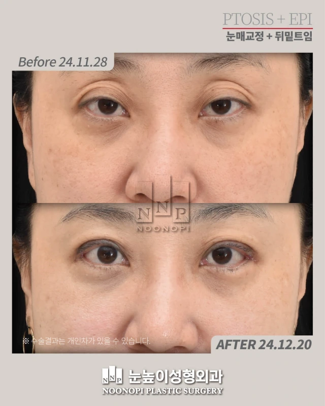 before after ptosis correction korea