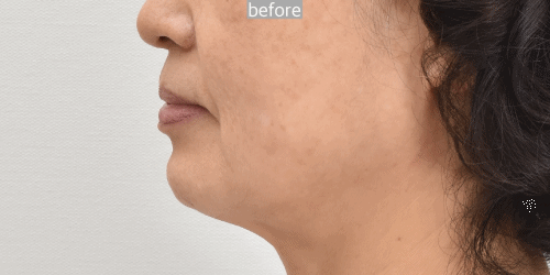 face and neck lift korea before after