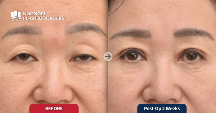 Ptosis surgery for uneven eyes results