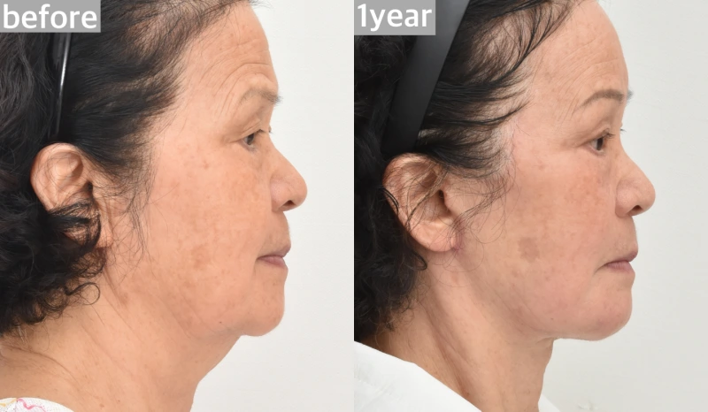 Along the margin of tragus incision case
