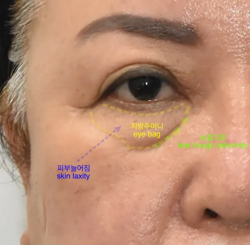 ثلاثة علامات للشيخوخة على الجفون السفلية: ترهل الجلد، وأكياس العين