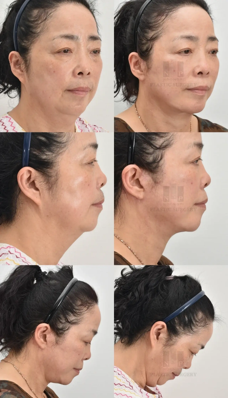 自然恢复期8个月后