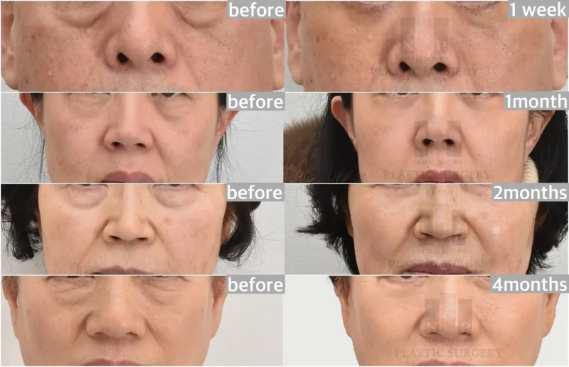 الجفن السفلي قبل وبعد