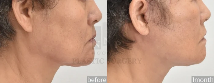 皮肤较厚是亚洲患者面部提升效果通常不如白种人显著的另一原因