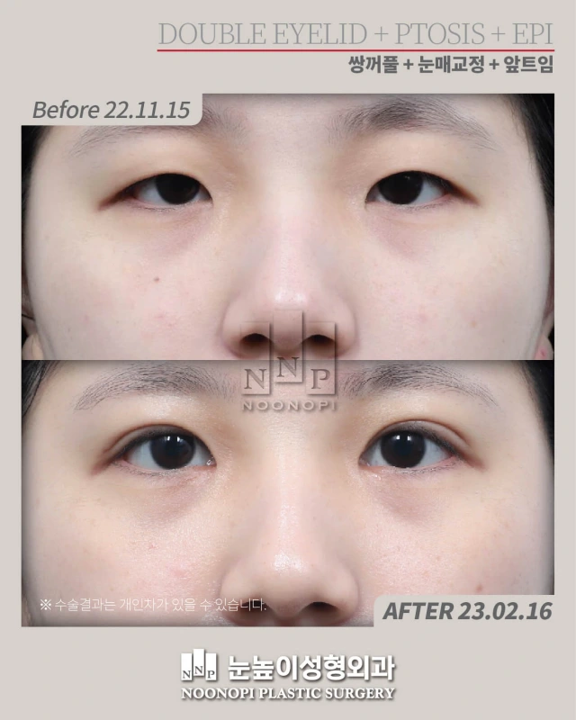 قبل وبعد جراحة الجفن المزدوج وتدلي الجفن