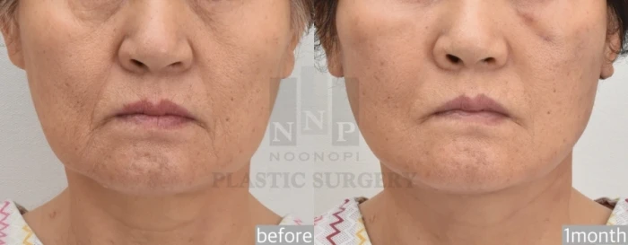 Stronger skeletal support and prominent malar bones are key factors that can make facelifting results appear less dramatic in Asian patients compared to Caucasians
