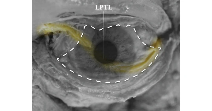 Illustration of LPTL restricting the levator muscle during surgery