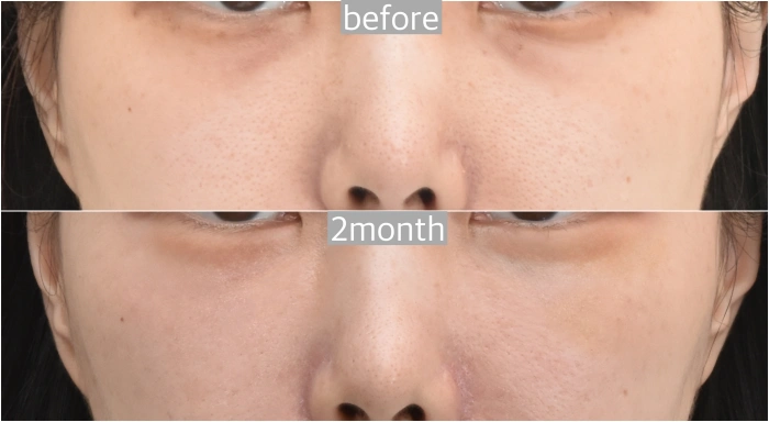 before after of Aegyo-sal fat graft in Noonopi Korea