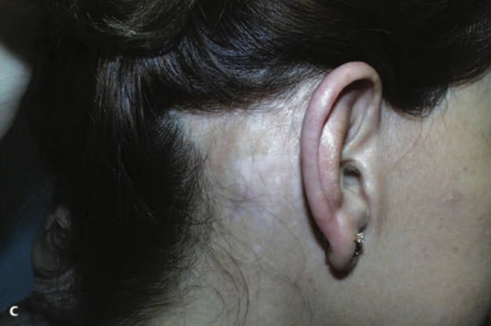 发际线内切口导致皮肤过度拉扯的案例