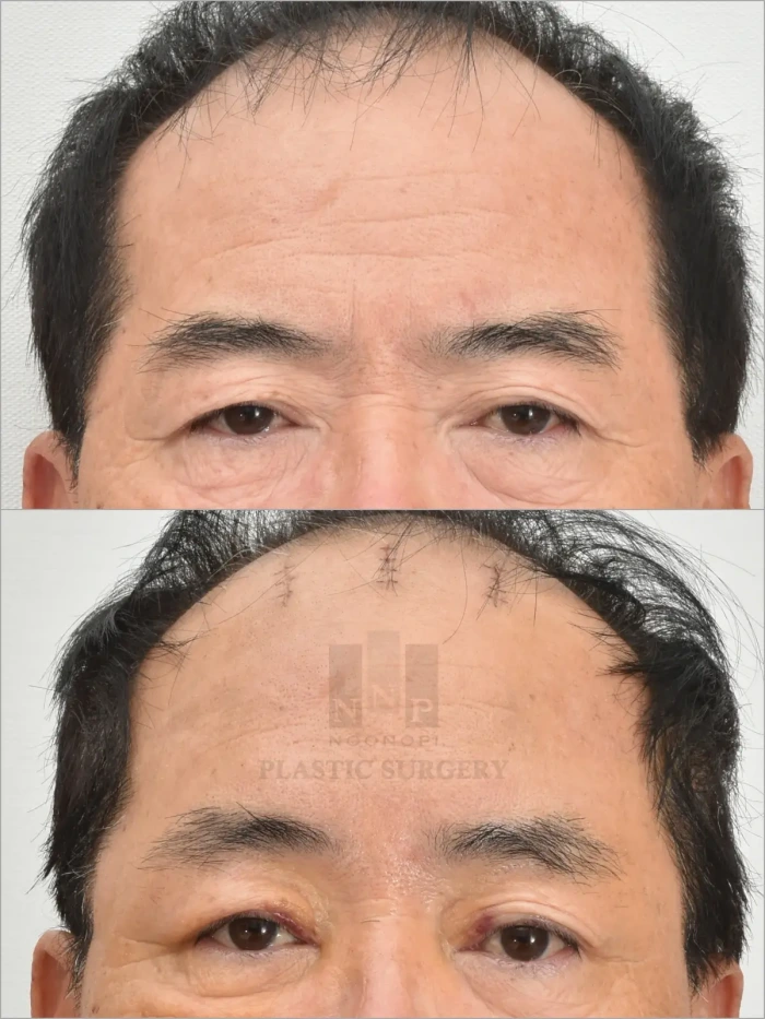 术后第1周恢复进程