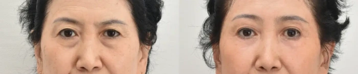 جراحة الجفن السفلي مع زراعة الدهون العلوية والسفلية، شد الجبهة من الداخل