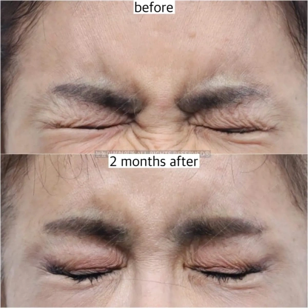 glabellar muscle are adequately removed during forehead lift