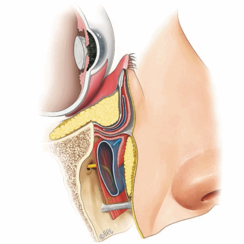经结膜下眼睑成形术示意图
